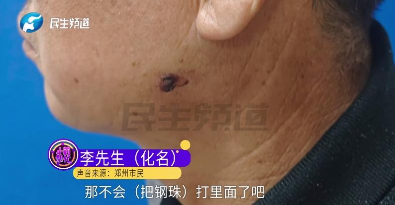 颌面钢珠异物取出_生活中磁铁的应用视频_面部磁力吸铁石
