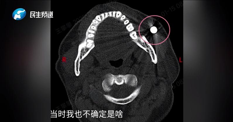 面部磁力吸铁石_颌面钢珠异物取出_生活中磁铁的应用视频