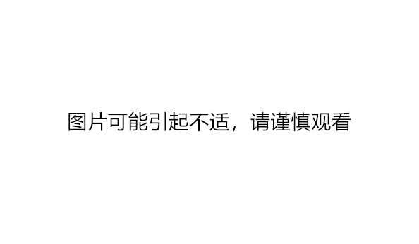 带状疱疹与水痘区别_带状疱疹症状识别_艾滋病 水痘