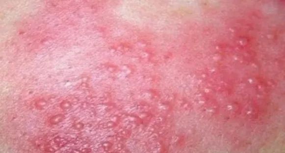 艾滋病 水痘_带状疱疹与水痘区别_带状疱疹症状识别