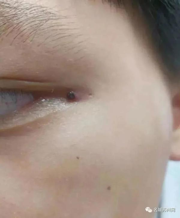 蜱虫叮咬症状_蜱虫叮咬预防措施_脾虫咬后的伤口图